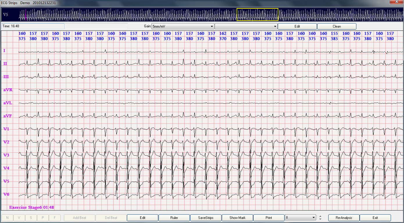 Revisión de las tiras ECG de la prueba de esfuerzo