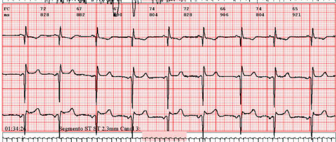 Muestra de las tiras ECG del CardioSCan